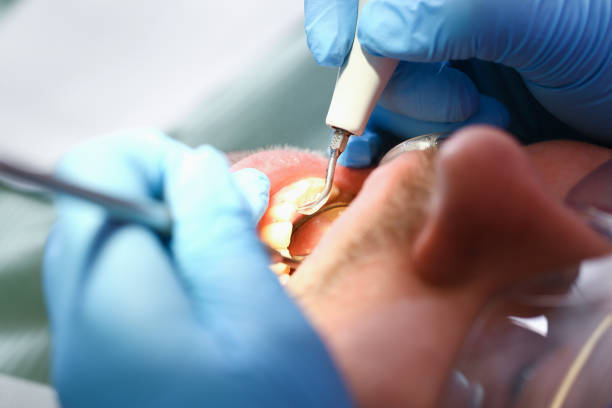 Best Emergency Wisdom Teeth Removal in Elmendorf, TX